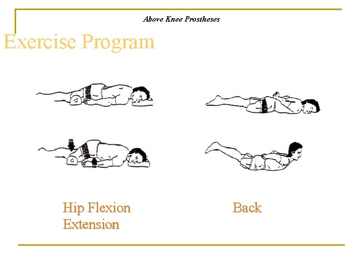 Above Knee Prostheses Exercise Program Hip Flexion Extension Back 