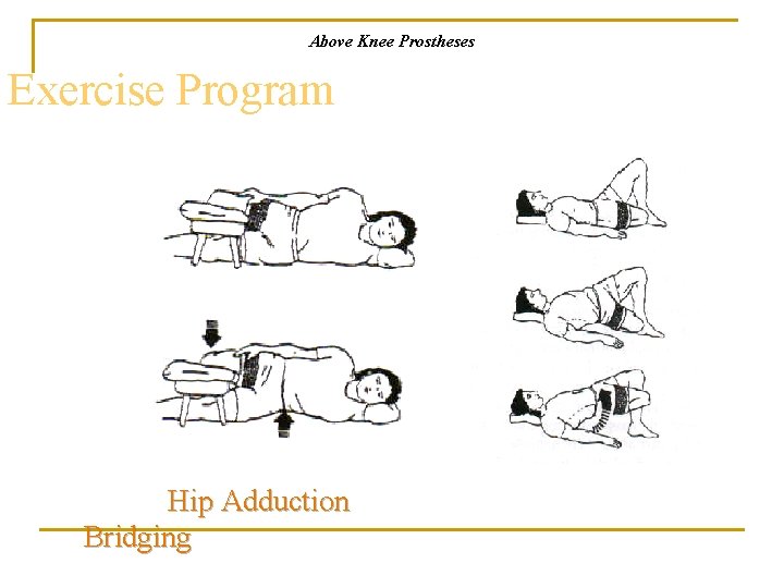 Above Knee Prostheses Exercise Program Hip Adduction Bridging 