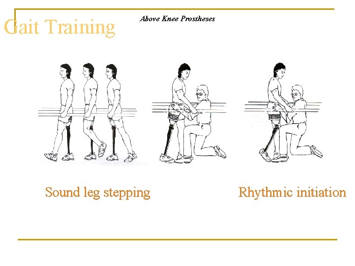 Gait Training Above Knee Prostheses Sound leg stepping Rhythmic initiation 