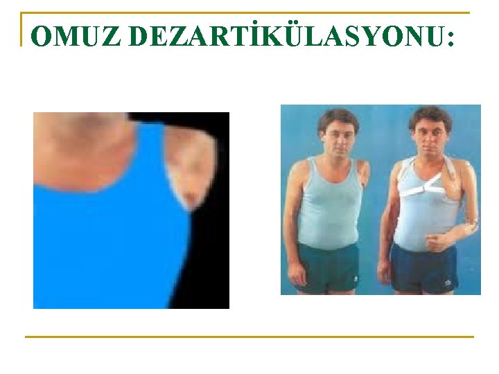 OMUZ DEZARTİKÜLASYONU: 