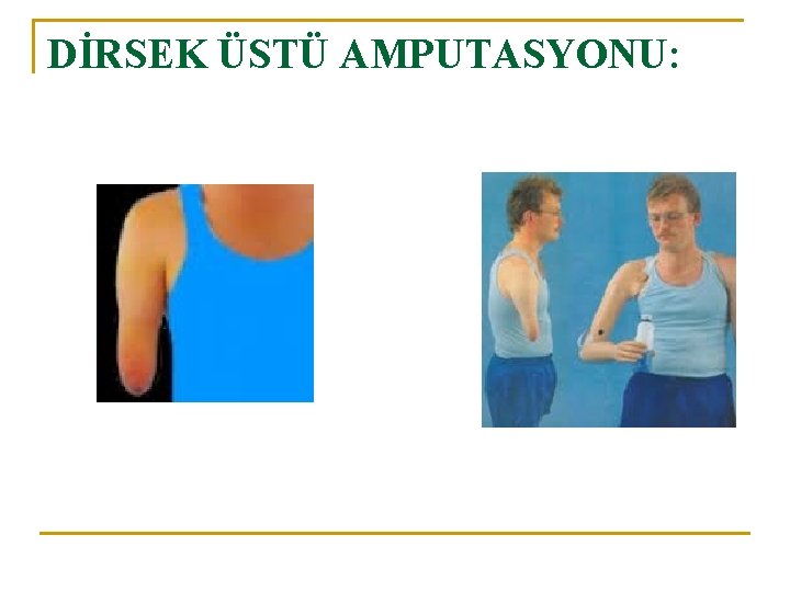 DİRSEK ÜSTÜ AMPUTASYONU: 