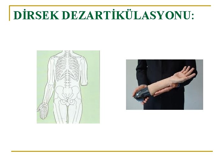 DİRSEK DEZARTİKÜLASYONU: 