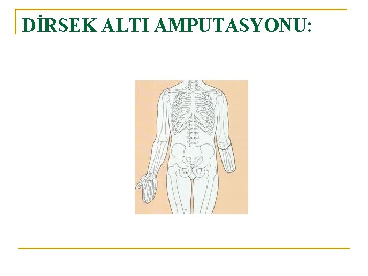 DİRSEK ALTI AMPUTASYONU: 