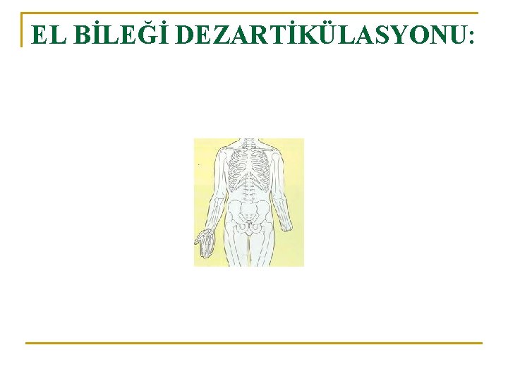 EL BİLEĞİ DEZARTİKÜLASYONU: 