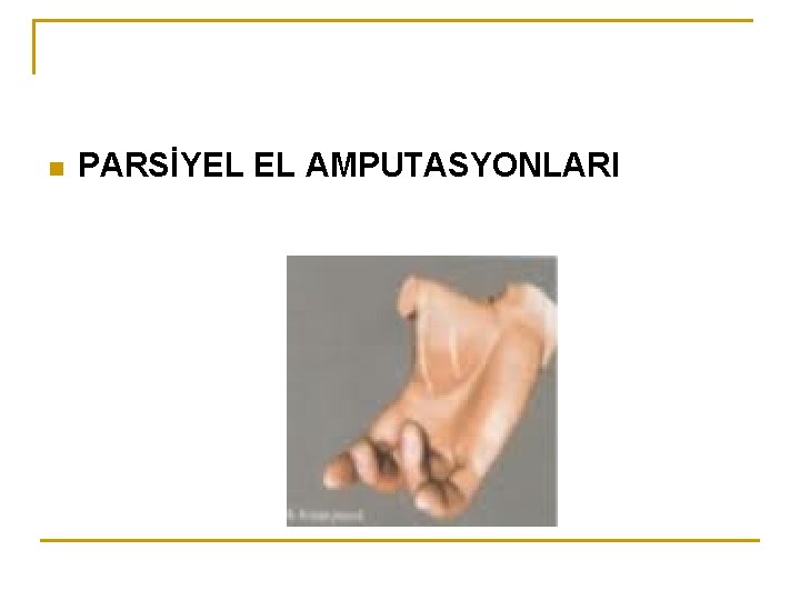 n PARSİYEL EL AMPUTASYONLARI 