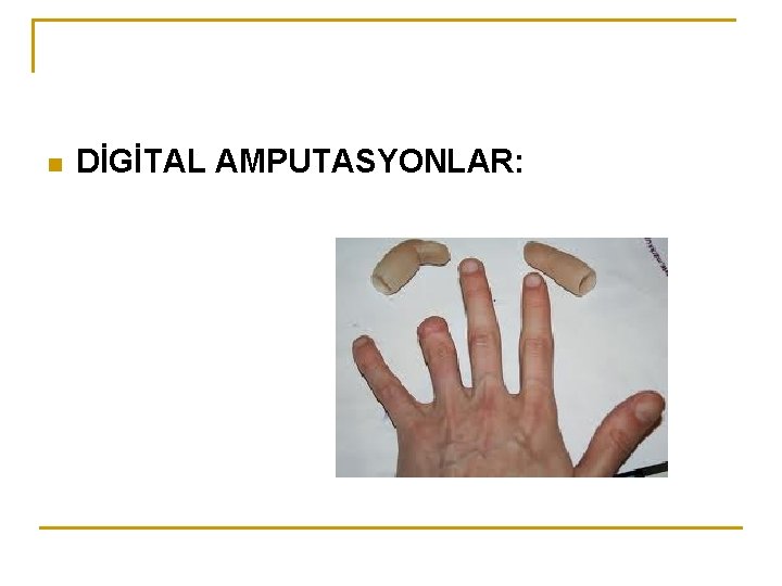 n DİGİTAL AMPUTASYONLAR: 