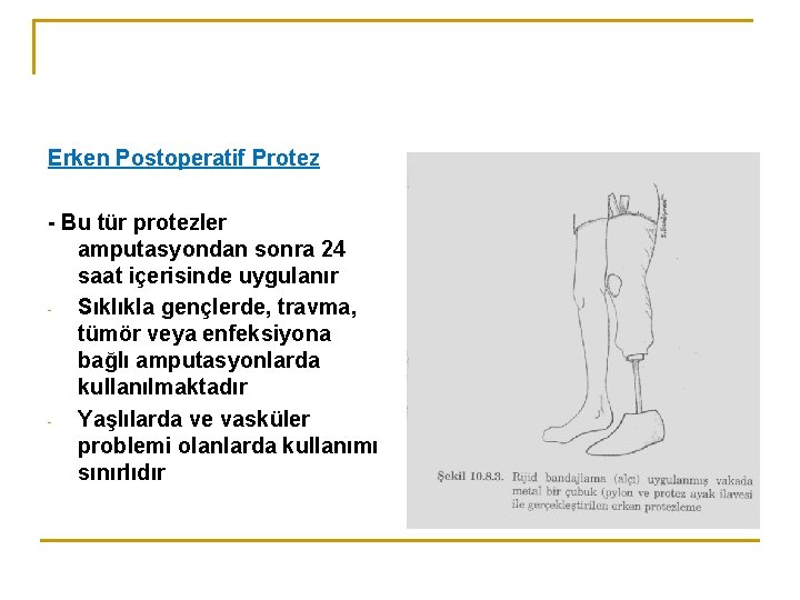 Erken Postoperatif Protez - Bu tür protezler amputasyondan sonra 24 saat içerisinde uygulanır Sıklıkla