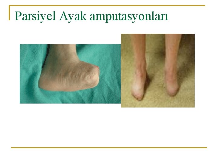 Parsiyel Ayak amputasyonları 