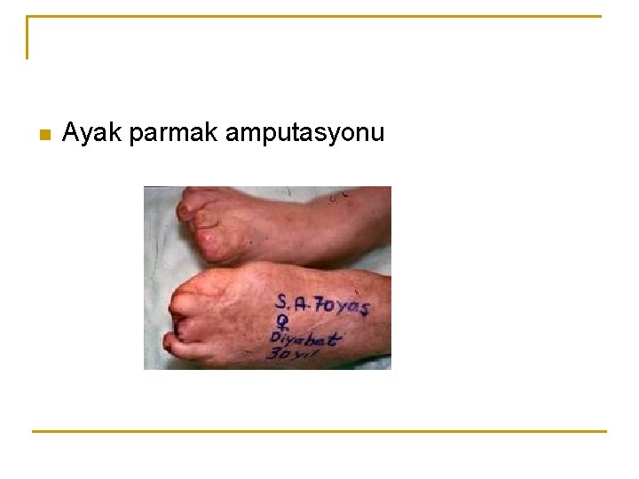 n Ayak parmak amputasyonu 