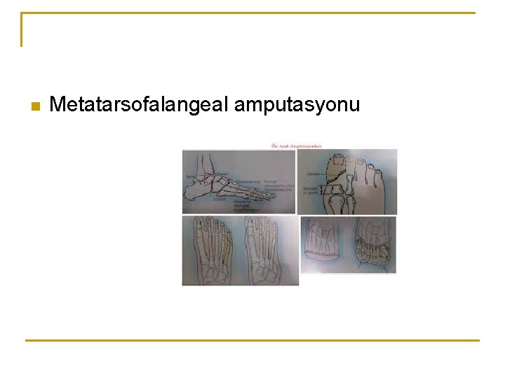 n Metatarsofalangeal amputasyonu 
