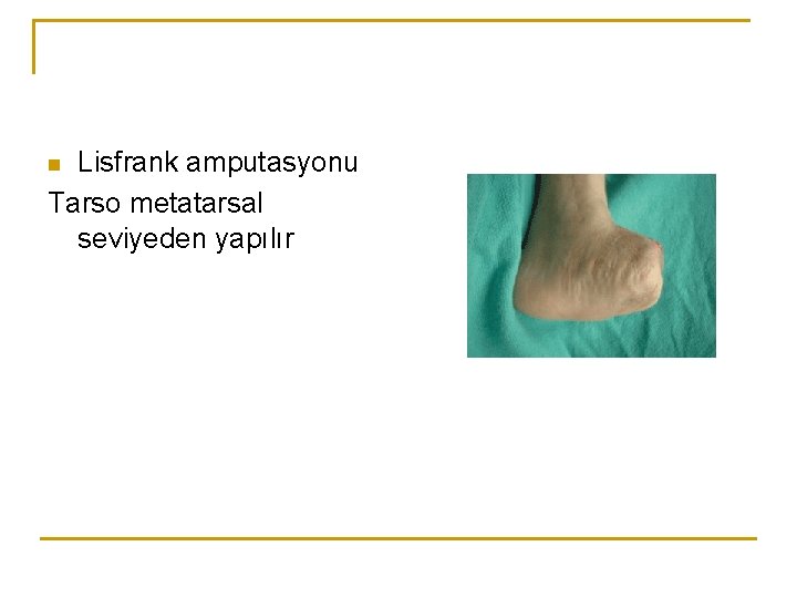 Lisfrank amputasyonu Tarso metatarsal seviyeden yapılır n 
