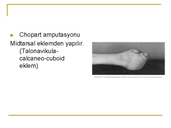 Chopart amputasyonu Midtarsal eklemden yapılır. (Talonavikulacalcaneo-cuboid eklem) n 