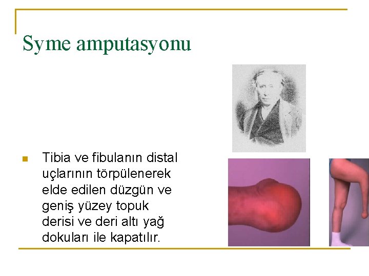 Syme amputasyonu n Tibia ve fibulanın distal uçlarının törpülenerek elde edilen düzgün ve geniş