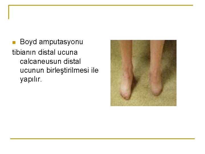 Boyd amputasyonu tibianın distal ucuna calcaneusun distal ucunun birleştirilmesi ile yapılır. n 