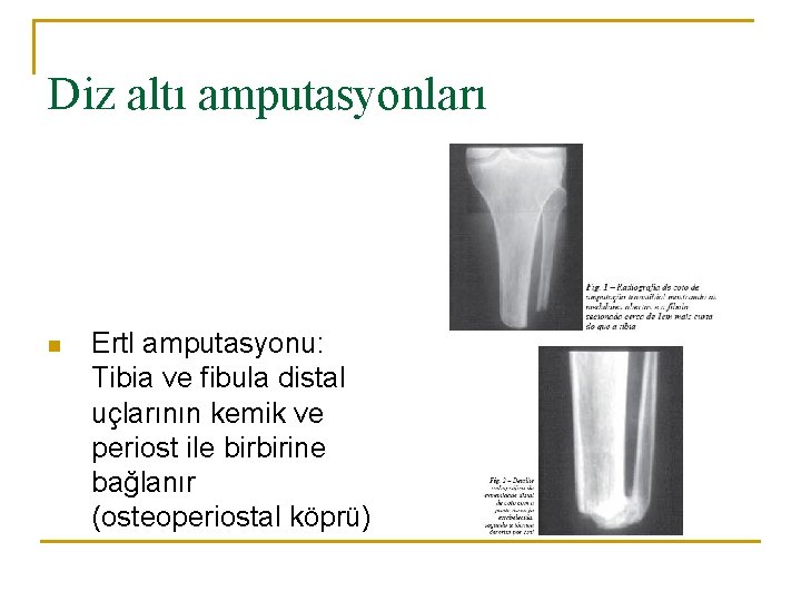 Diz altı amputasyonları n Ertl amputasyonu: Tibia ve fibula distal uçlarının kemik ve periost
