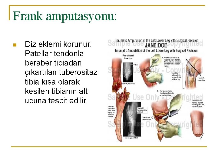 Frank amputasyonu: n Diz eklemi korunur. Patellar tendonla beraber tibiadan çıkartılan tüberositaz tibia kısa