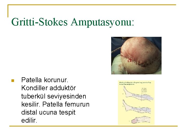 Gritti-Stokes Amputasyonu: n Patella korunur. Kondiller adduktör tuberkül seviyesinden kesilir. Patella femurun distal ucuna