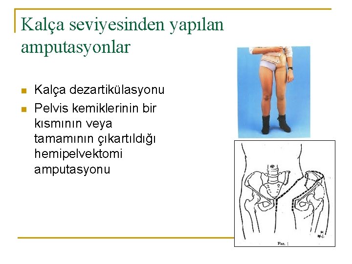Kalça seviyesinden yapılan amputasyonlar n n Kalça dezartikülasyonu Pelvis kemiklerinin bir kısmının veya tamamının
