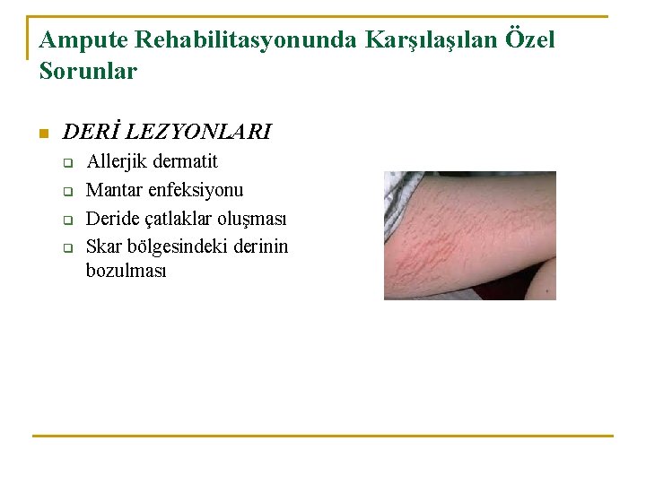 Ampute Rehabilitasyonunda Karşılan Özel Sorunlar n DERİ LEZYONLARI q q Allerjik dermatit Mantar enfeksiyonu