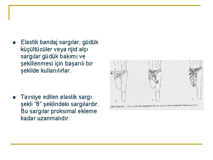 n Elastik bandaj sargılar, güdük küçültücüler veya rijid alçı sargılar güdük bakımı ve şekillenmesi
