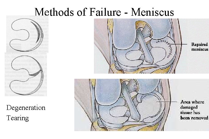 Methods of Failure - Meniscus Degeneration Tearing 