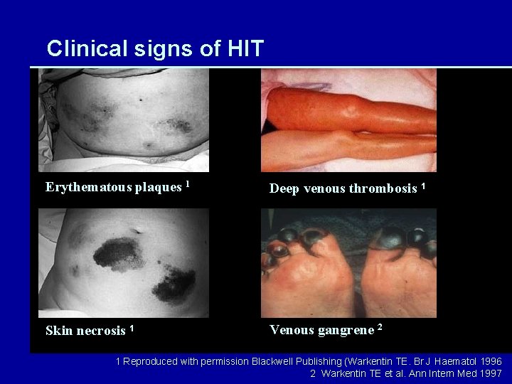Clinical signs of HIT Erythematous plaques 1 Deep venous thrombosis 1 Skin necrosis 1