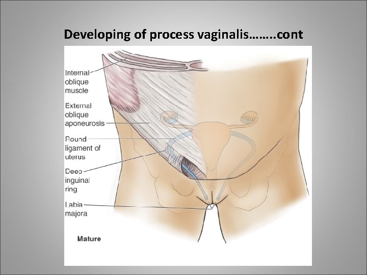 Developing of process vaginalis……. . cont 