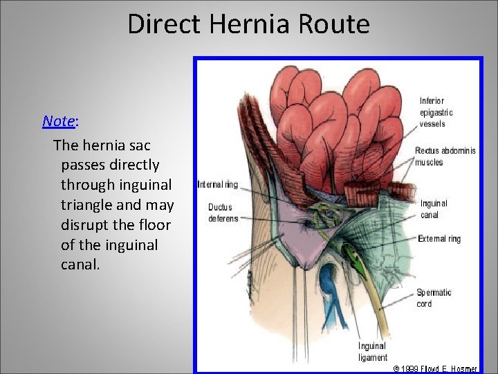 Direct Hernia Route Note: The hernia sac passes directly through inguinal triangle and may