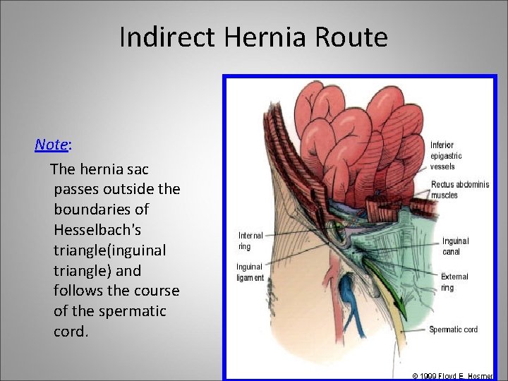 Indirect Hernia Route Note: The hernia sac passes outside the boundaries of Hesselbach's triangle(inguinal