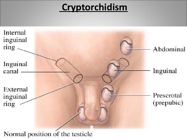 Cryptorchidism 