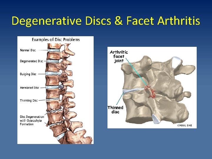Degenerative Discs & Facet Arthritis 