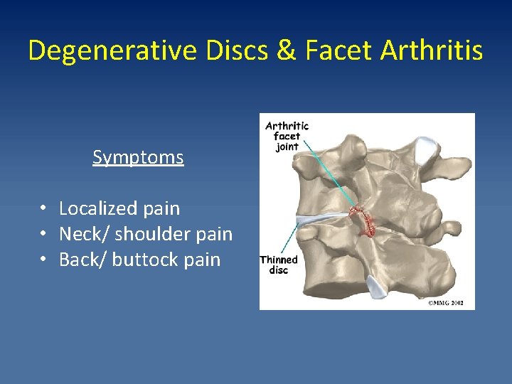 Degenerative Discs & Facet Arthritis Symptoms • Localized pain • Neck/ shoulder pain •