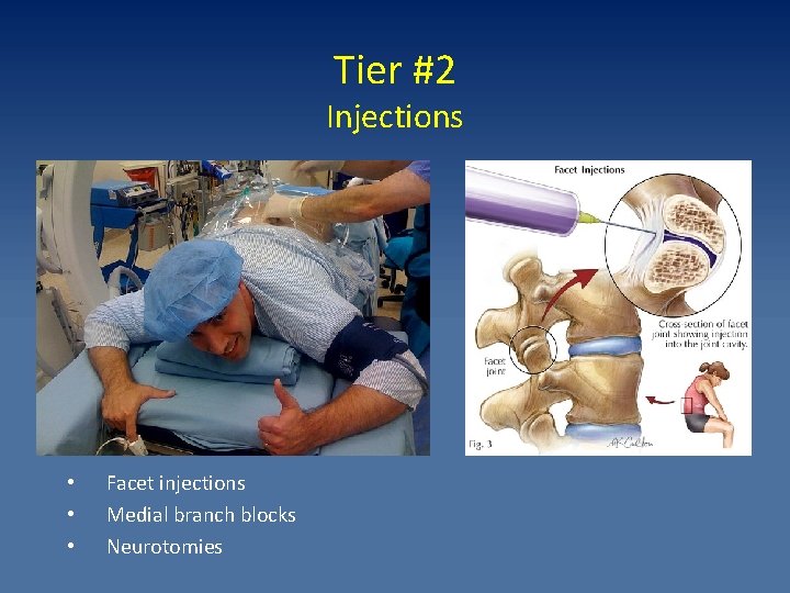 Tier #2 Injections • • • Facet injections Medial branch blocks Neurotomies 