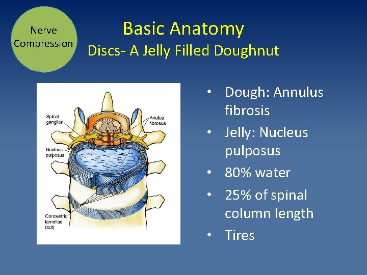 Nerve Compression Basic Anatomy Discs- A Jelly Filled Doughnut • Dough: Annulus fibrosis •