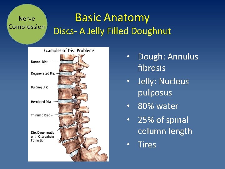 Nerve Compression Basic Anatomy Discs- A Jelly Filled Doughnut • Dough: Annulus fibrosis •