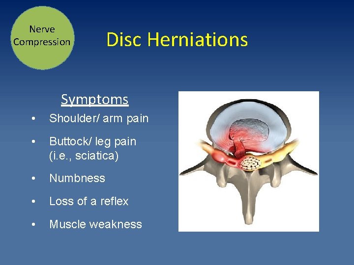 Nerve Compression Disc Herniations Symptoms • Shoulder/ arm pain • Buttock/ leg pain (i.