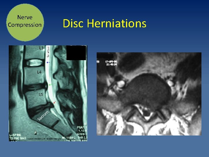 Nerve Compression Disc Herniations 