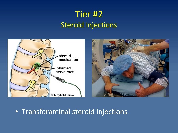 Tier #2 Steroid Injections • Transforaminal steroid injections 