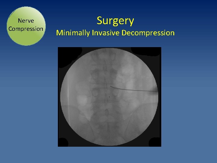 Nerve Compression Surgery Minimally Invasive Decompression 