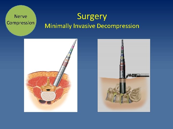 Nerve Compression Surgery Minimally Invasive Decompression 