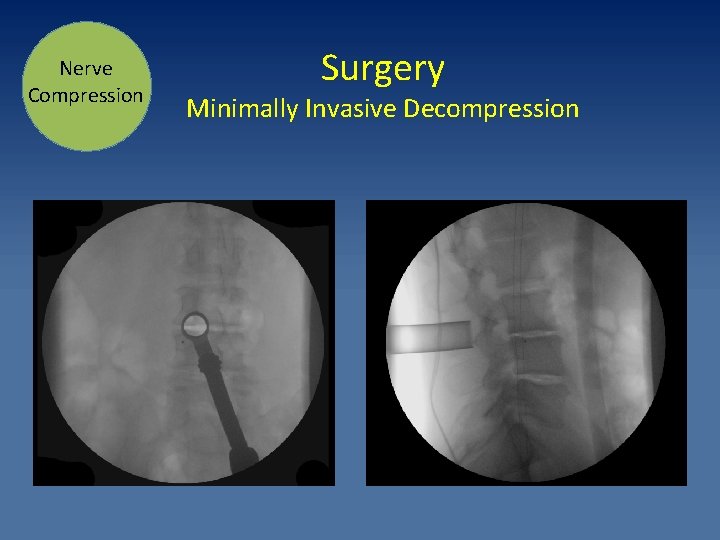 Nerve Compression Surgery Minimally Invasive Decompression 