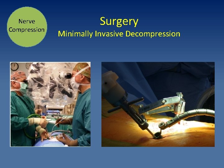 Nerve Compression Surgery Minimally Invasive Decompression 