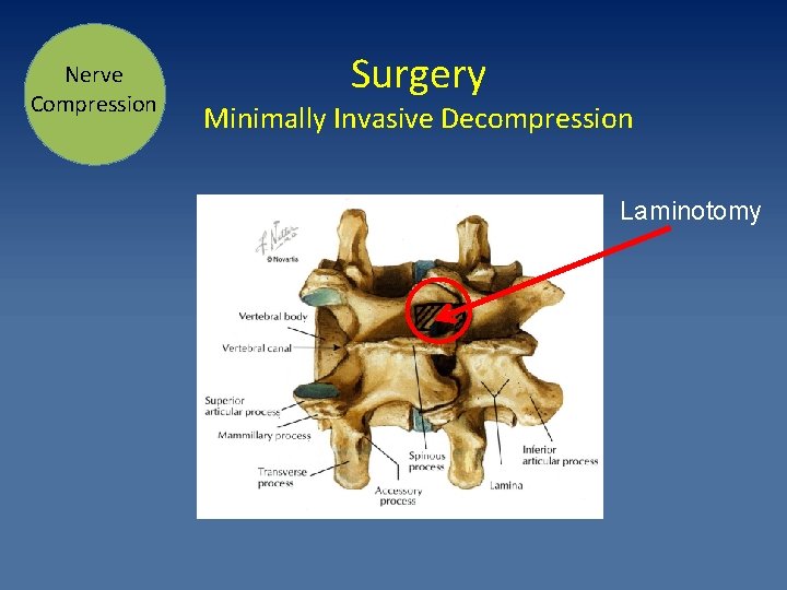 Nerve Compression Surgery Minimally Invasive Decompression Laminotomy 