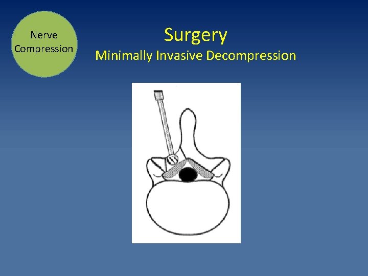 Nerve Compression Surgery Minimally Invasive Decompression 