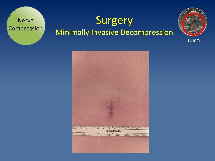 Nerve Compression Surgery Minimally Invasive Decompression 18 mm 