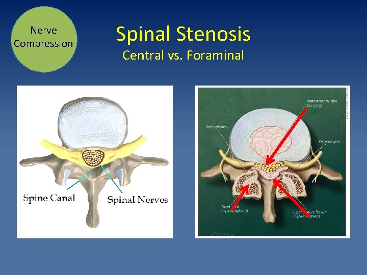 Nerve Compression Spinal Stenosis Central vs. Foraminal 