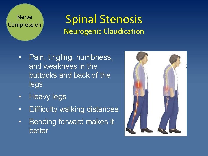 Nerve Compression Spinal Stenosis Neurogenic Claudication • Pain, tingling, numbness, and weakness in the