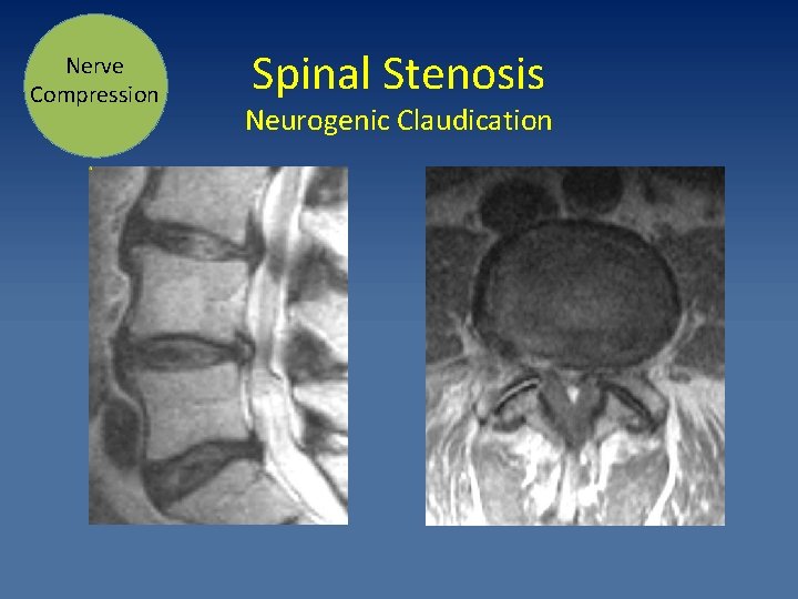 Nerve Compression Spinal Stenosis Neurogenic Claudication 