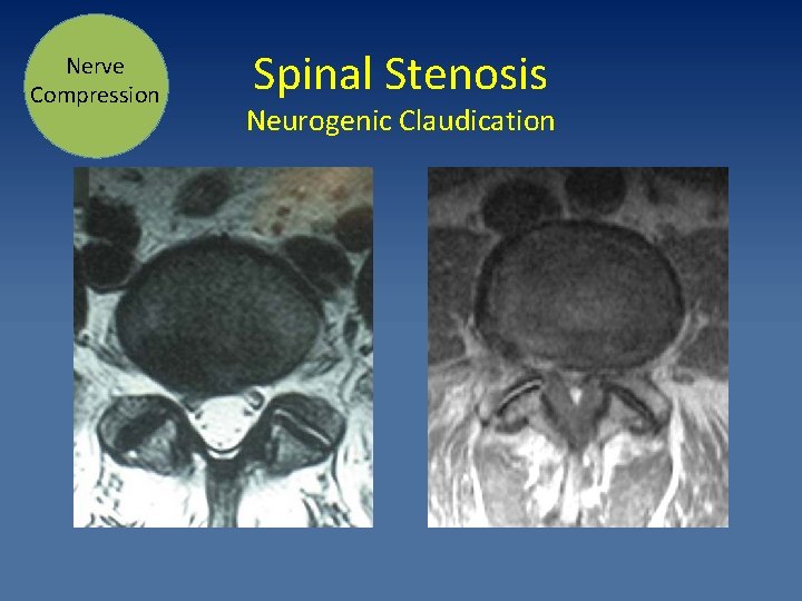 Nerve Compression Spinal Stenosis Neurogenic Claudication 