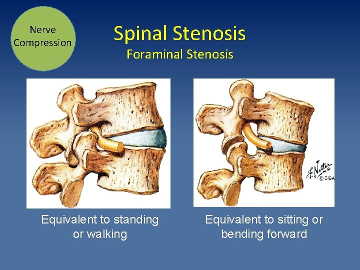 Nerve Compression Spinal Stenosis Foraminal Stenosis Equivalent to standing or walking Equivalent to sitting